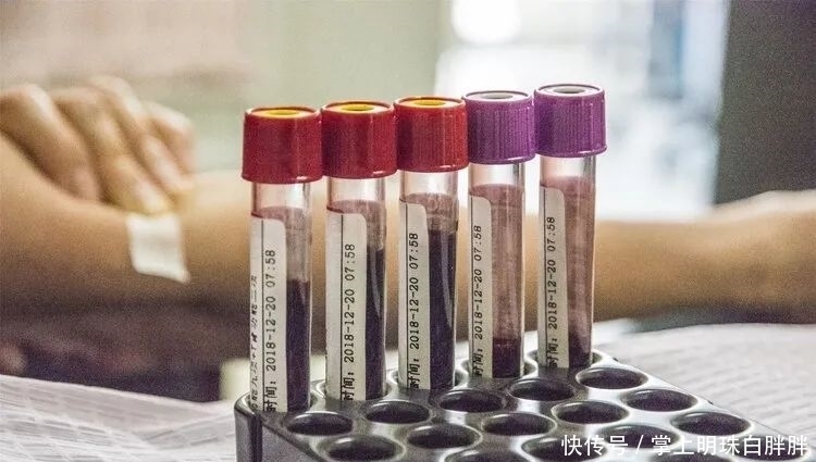 做了血脂检查怎么看报告,只要异常就需要吃药吗?