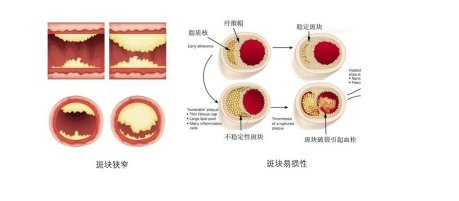 服用|曾运雄博士指出：从“心”做起，心血管疾病可控可防