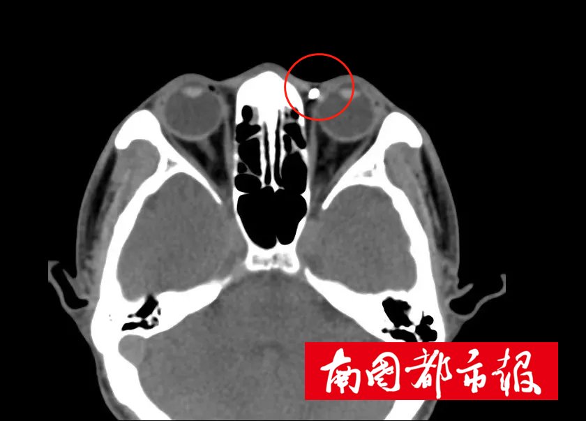异物|一颗“铁豌豆”在乐东男子眼睛里藏了3年，他竟浑然不知！