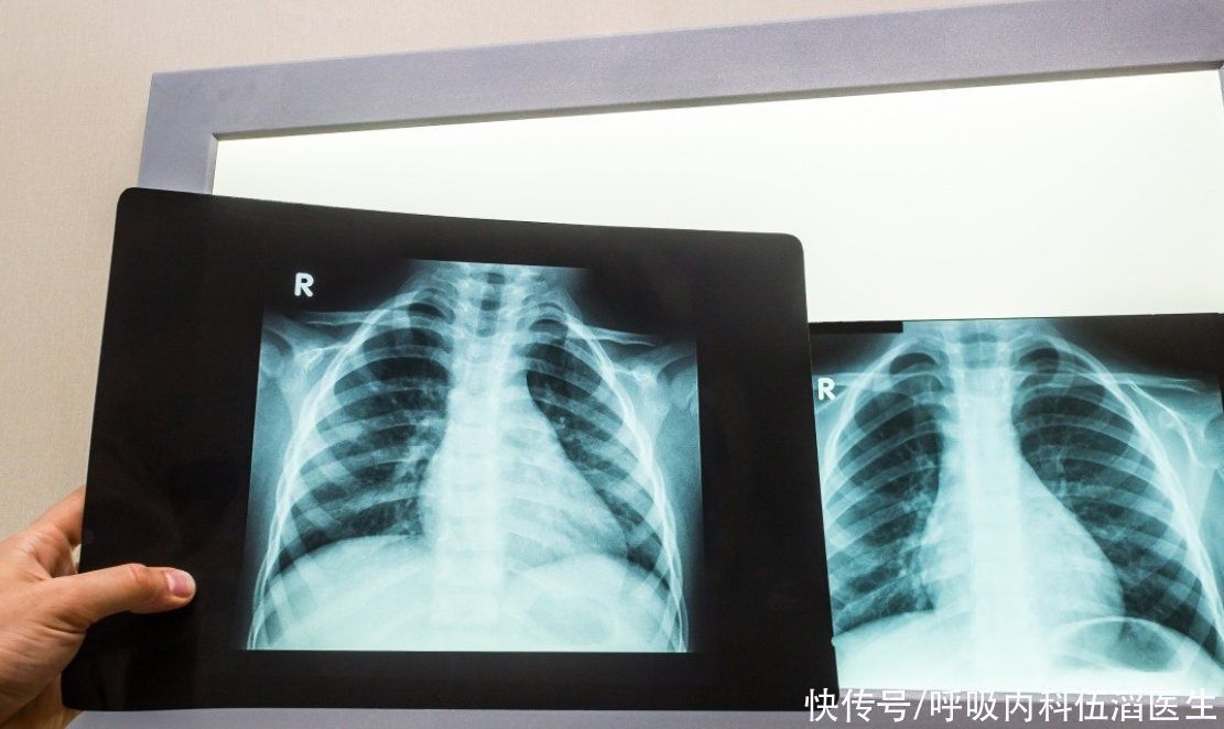 阴影|女教师体检发现阴影,迷糊不细究,4年后医生痛责,已发展成肺癌