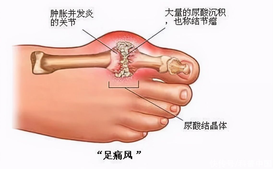 快收好！各年龄段血压、血糖、血脂、尿酸对照表全在这…