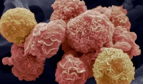 阴茎癌|引发宫颈癌的原因是什么?宫颈癌日常应该注意哪些方面?