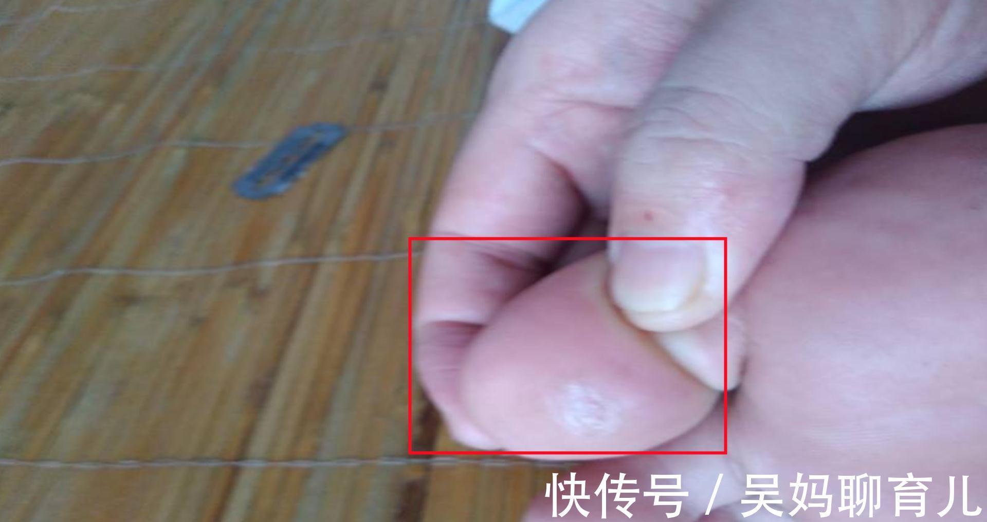 截肢|糖尿病男子修“鸡眼”,差点要截肢,“糖人”要注意