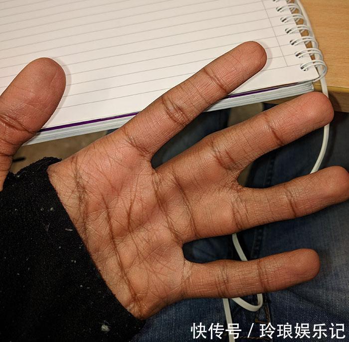 脚趾|19个“被上帝挑选过”的特殊基因人类,怎么梳都不整齐的头发