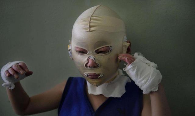 家长|孩子被烫伤后,是先脱衣服还是先冲冷水家长一定要提前知道