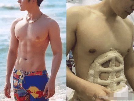 手术|24岁小哥花26000通过手术雕出6块腹肌,恢复后像填充棉絮的布偶