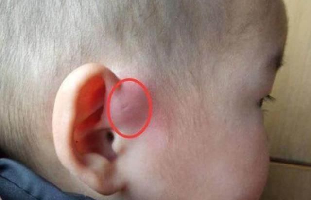 家长|为什么有的新生儿耳朵有“小孔”?医生一般不说,家长心中要有数
