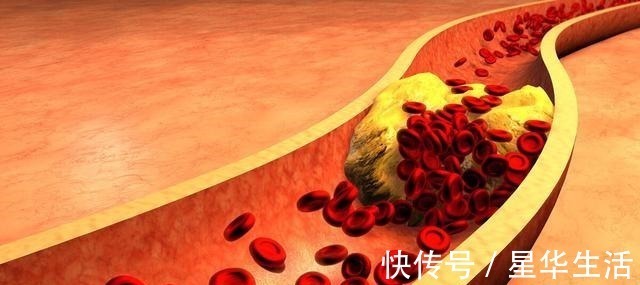 甘油三酯|血脂升高是肉吃多了辟谣并非如此!告诉您血脂升高的真相!