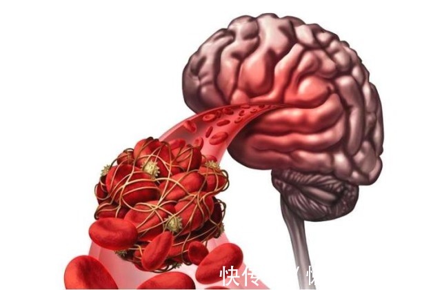 陈醋|血管的“软化剂”被揪出，不是老陈醋，你若爱喝，远离脑梗