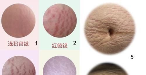 润肤|四胞胎妈妈身材“太好”走红网络,她掀起衣服后,网友都捂住了嘴