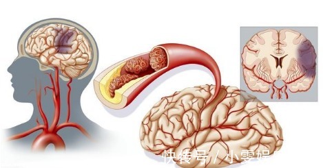糖尿病足|糖尿病出现这6大表现,证明糖尿病并发症出现,血糖控制不好