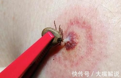 蜱虫叮咬的症状图片怎么样,家里如何消杀蜱虫