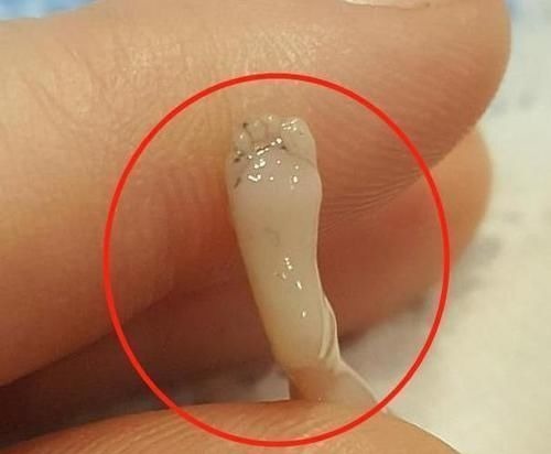 后遗症|女子怀孕14周流产,“胎儿”照片曝光!指甲盖都能看得清清楚楚