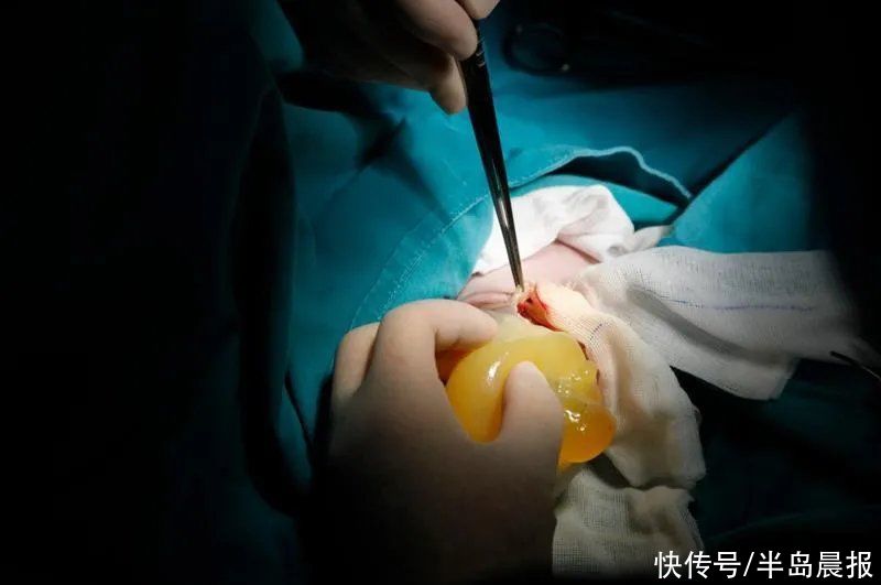 有惊无险！新生宝宝肝脏＂挂＂在肚子外，幸好……这病男宝宝多发
