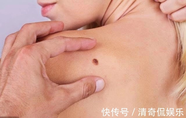 嘴唇|4个部位长了痣,最好定期检查,癌症可能会悄悄接近你