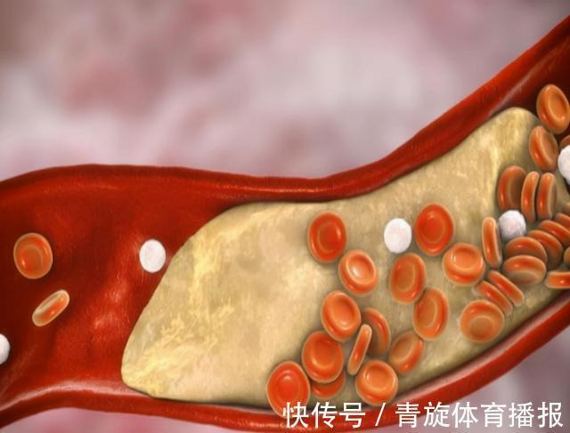 脂肪类|胆固醇、甘油三酯、脂蛋白超标？血脂与日常饮食关系多大？如何调