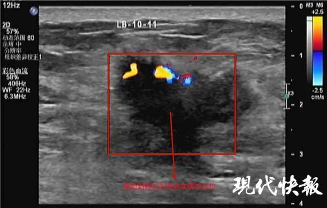 发育|79 岁的男人乳房突然发育，增大如“鸭蛋”！