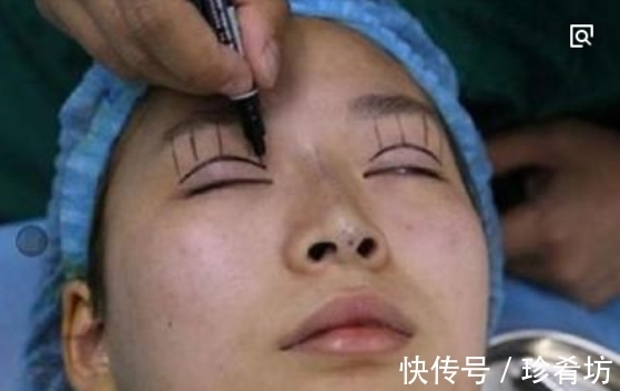 双眼皮 手术割了双眼皮的人,老了之后有什么影响?看完真要留意了