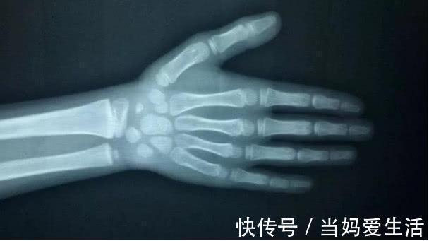 炸鸡|9岁女孩来“例假”,骨龄超同龄人两岁,只因爱吃妈妈做的这道菜