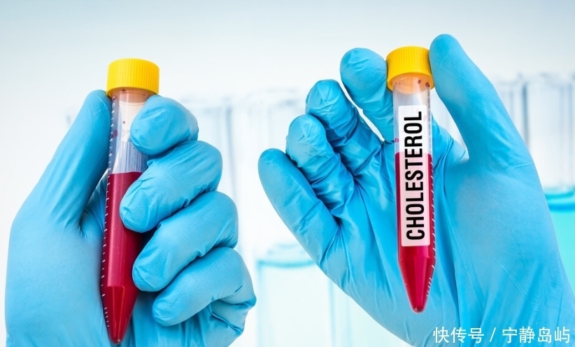 低密度脂蛋白偏高,3种食物劝你“口下留情”,别让血管堵死