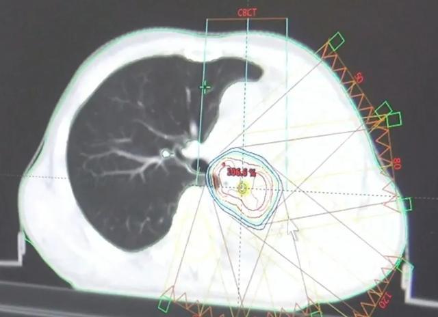 放疗|左肺被肿瘤堵死缩成一团，放疗后吐出一块“鱼肉”，肺瞬间充满