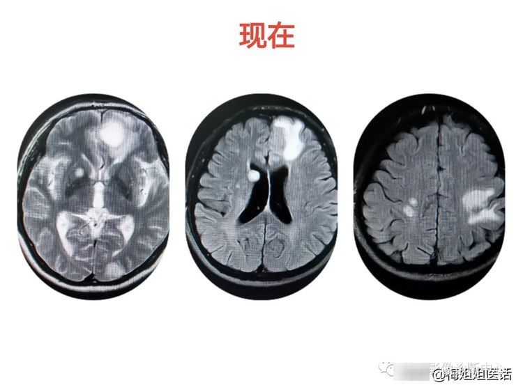 患者|从肺结节到肺癌，10个月影像记录，提醒我们正确对待肺结节处理