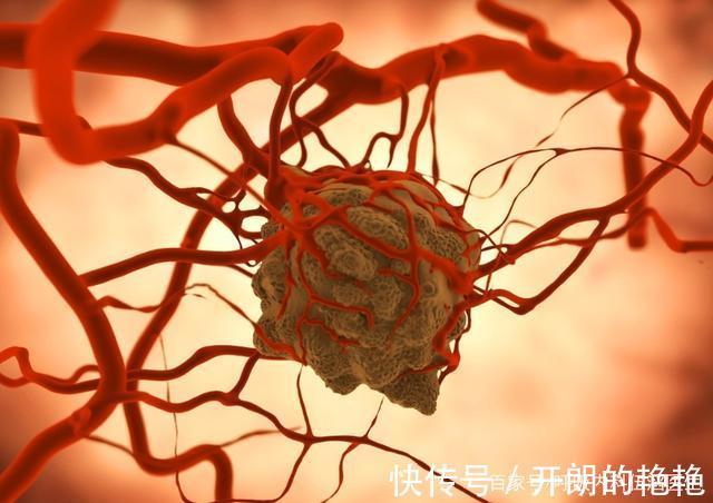 医生|肺癌来临,睡觉先知!医生有话说肺部有癌的人,睡觉有这些表现