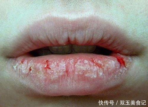 嘴唇|嘴唇总是反复干裂、起皮咋办?别撕别舔,4个非常润唇法教会你