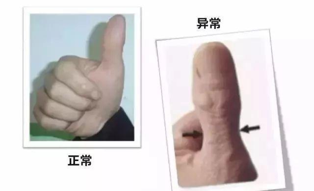 老李|46岁男子,不痛不痒,查出肺癌,手上1个标记,提示已到中晚期