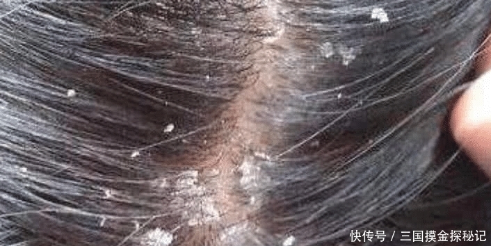 头皮|为什么头皮上会有这么多白色颗粒“状物”,你不知道的这3件事!