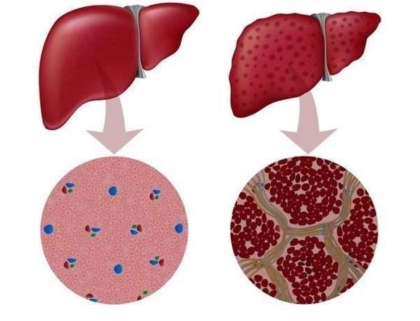 消化道出血|放屁多不是好事,或许是肝硬化正在“靠近”,3个调理方法请收好