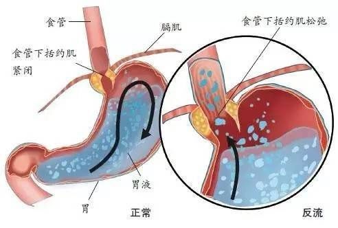 治疗|总反酸烧心，胃镜查不出问题，到底是病吗？应该如何治疗？