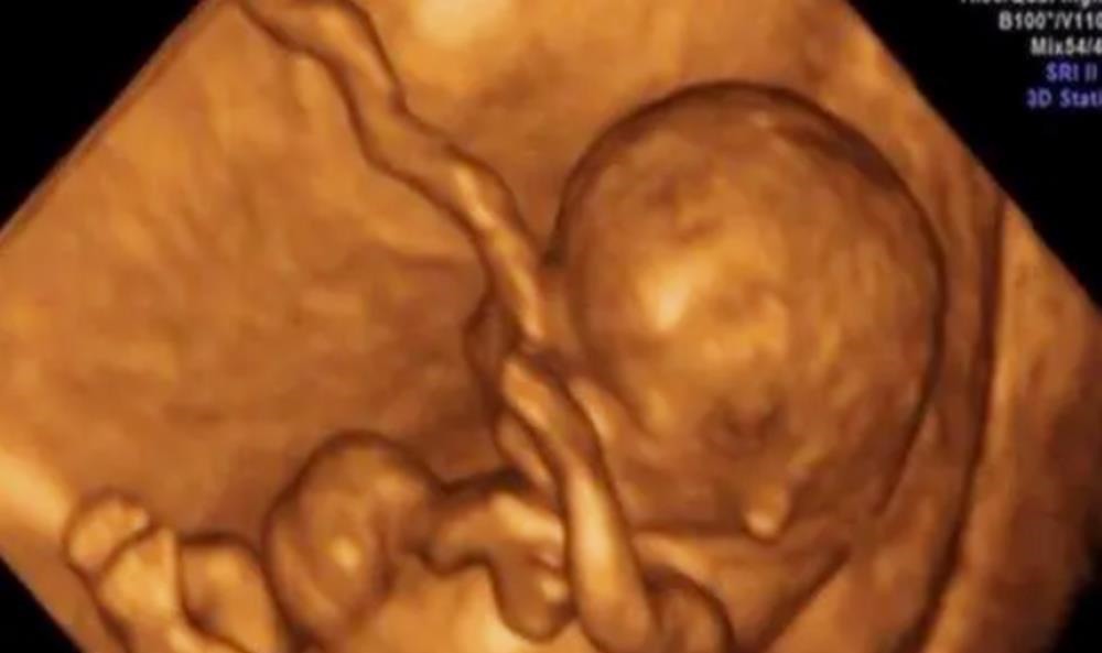 四维彩超|做四维彩超后,不做这步相当于“白花钱”,在检查前孕妈要问明白