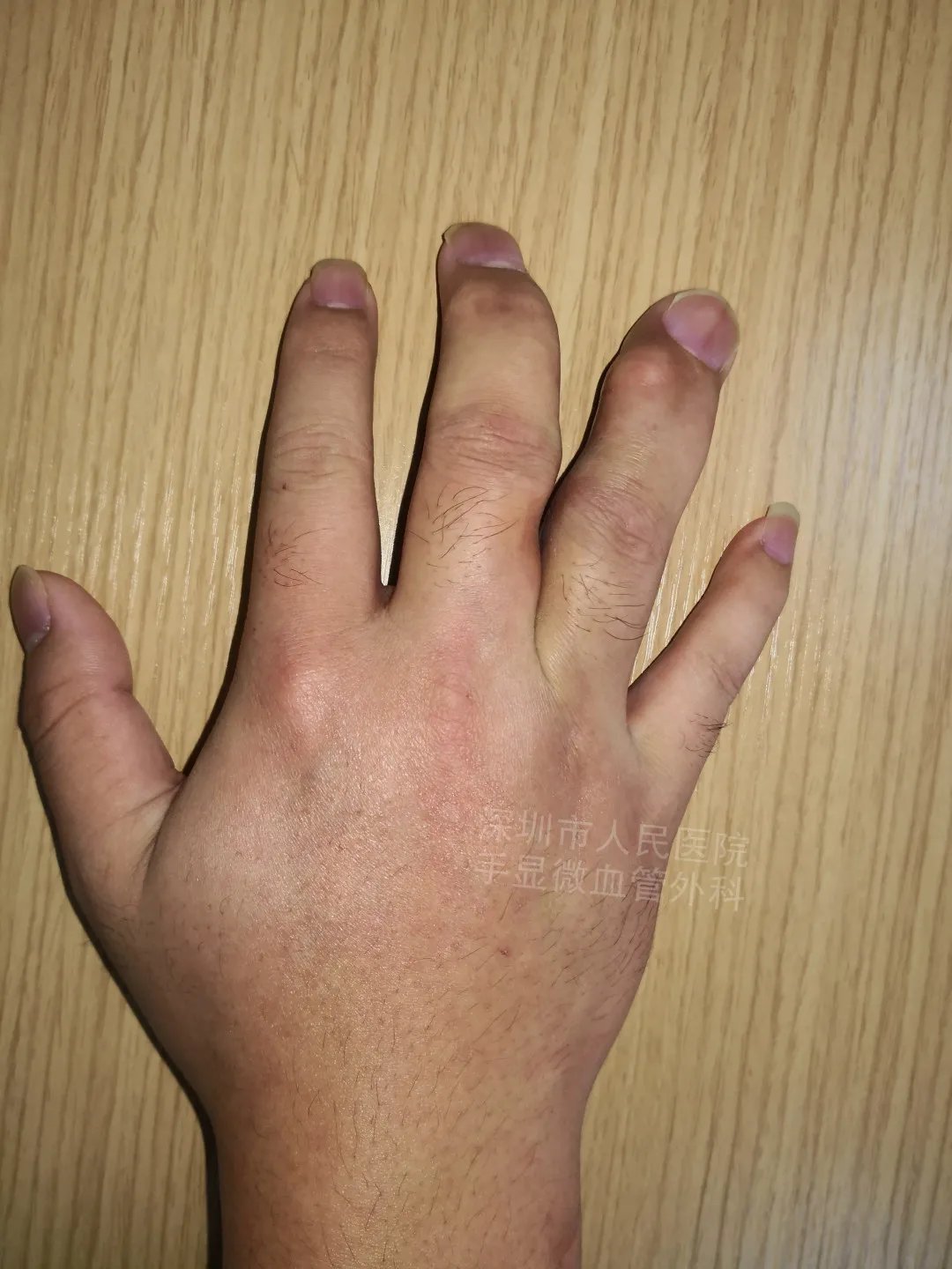 发育不良|得了这病，12岁男孩手指比香蕉还粗！7种常见的手部畸形，家长们要注意