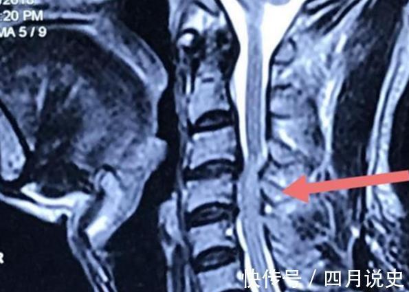 mri|下肢无力,肌肉跳动,走路像踩棉花?可能是颈椎脊髓压迫症