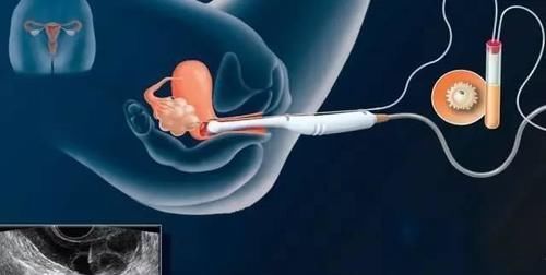 卵子|越来越多的人选择做“试管婴儿”,试管婴儿与正常人一样健康吗?