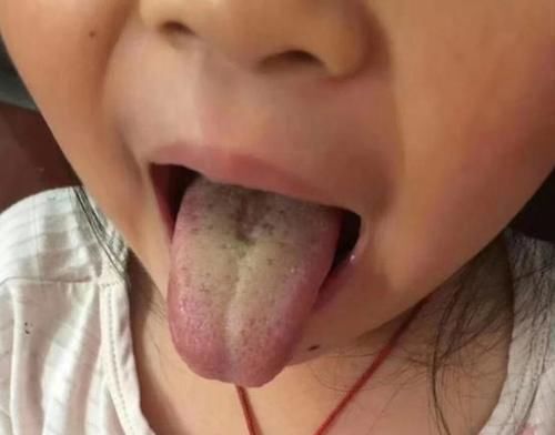 猴头菇|孩子反复积食,这些表现要引起重视,别再拖延