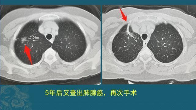 病人|查出癌症不放疗不化疗，保持良好心态吃喝玩乐，能扛过去吗