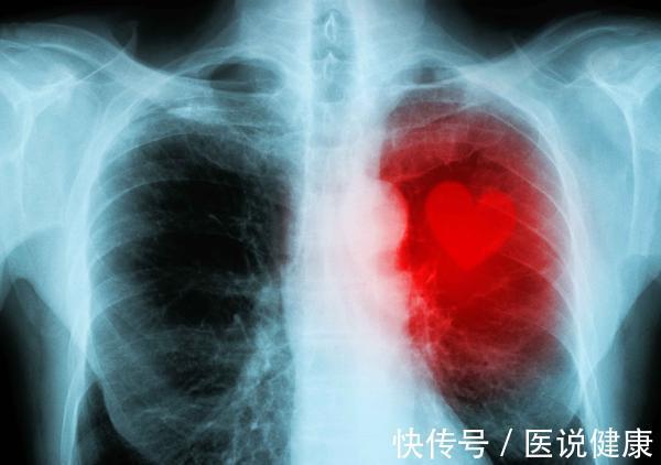 气体|肺癌是如何发生的?这4个高危因素,或是肺癌主要原因,尽量避开