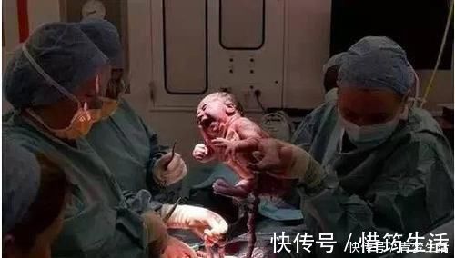 准妈妈|超预产期5周,准妈还在家“待产养胎”,取出孩子后医生无奈摇头