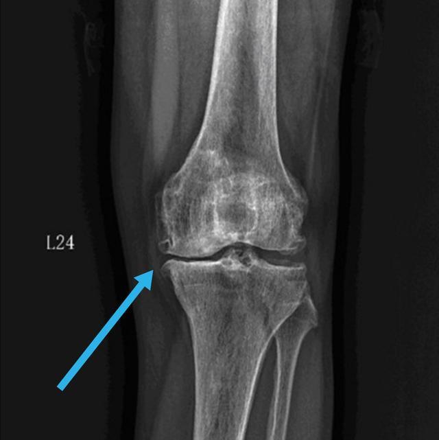 膝关节|膝关节很奇怪,上下楼梯,蹲起蹲起就疼,走平路不疼,咋回事