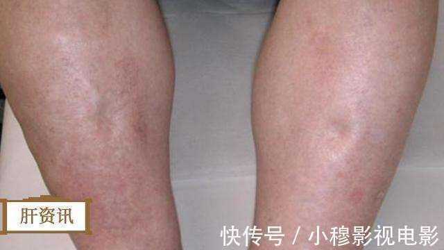 治疗|早期肝硬化可逆转,身上长出这些,抓住治疗黄金期,肝硬化好一半