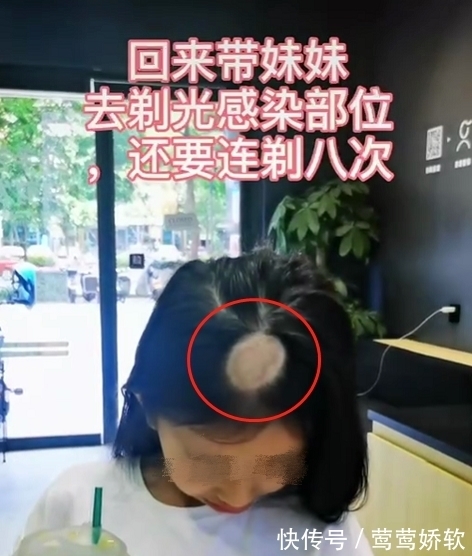 皮肤科|10天不到,小女孩头顶秃了,做这事千万慎重
