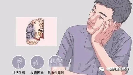 平衡障碍|小脑萎缩早期常见的四大症状
