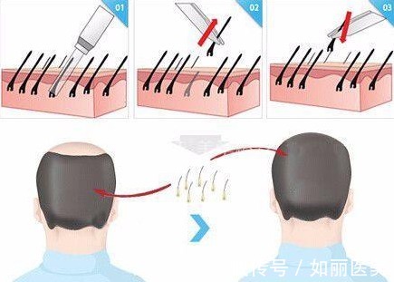 发际线 发际线种植术后原来需要这样护理！正确增加毛囊存活率