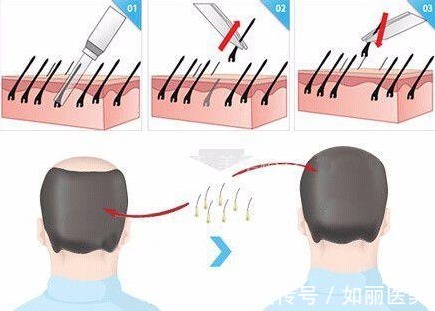 发际线 发际线种植术后原来需要这样护理!正确增加毛囊存活率