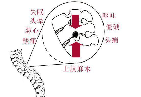 按摩|被颈椎病折磨了两年,才知道常按摩这个穴位安全又高效!
