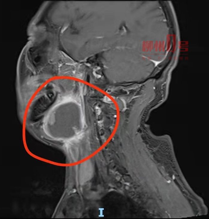 柳州|长溃疡不放心上？来柳州一查竟是口腔癌晚期：肿瘤长成鸡蛋大小