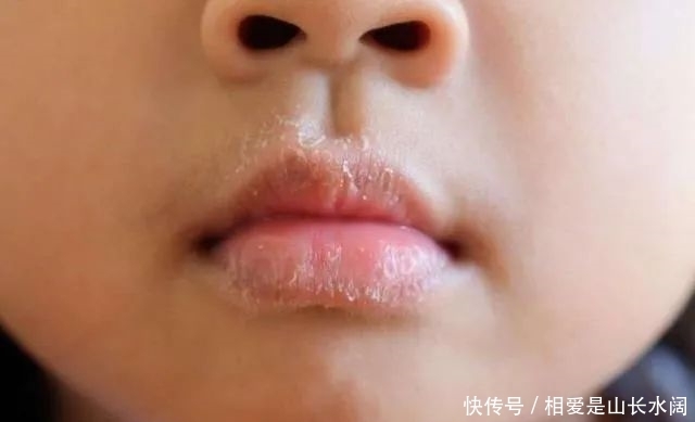 嘴巴|小儿推拿杨晓:宝宝嘴巴干燥起皮?如何通过小儿推拿和食疗调理?
