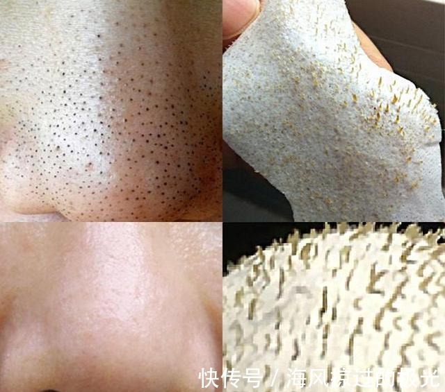 泡沫|看到黑头就想挤担心越挤越多！网上3种方法才损伤皮肤，要避开
